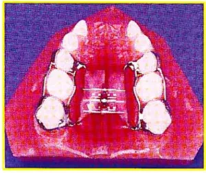 Figure 3: Appareil de Huas