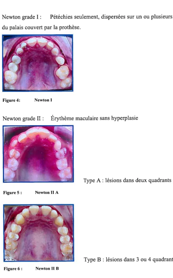 Figure 5 Newton Il A