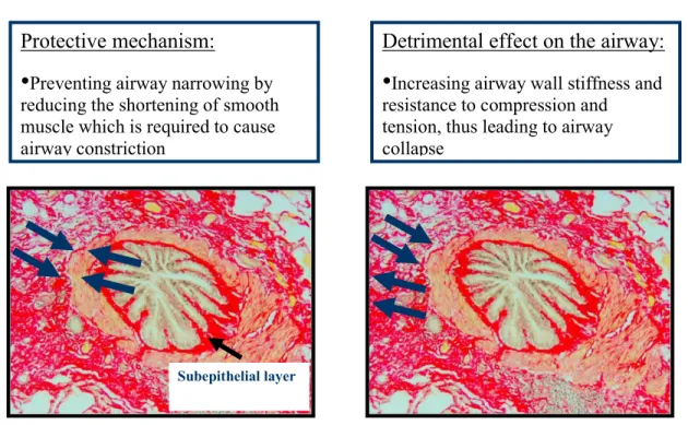 Figure 4  Possible impacts of subepithelial remodelling on the airway lumen caliber 