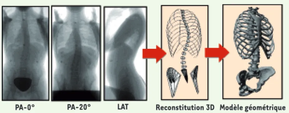 Figure 1. Prise de radiographies calibrées. Un algorithme de reconstruction 3D permet d’obtenir  la position 3D de primitives associées aux structures osseuses internes (modèle filaire)