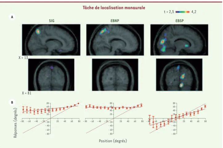Figure 3. Localisation sonore et tomographie par émission de positons (TEP). A. Activations cérébrales lors de la tâche de localisation monaurale