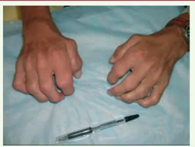 Figure 1. Déformations articulaires (« mains en griffe ») chez un patient atteint  d’une mucopolysaccharidose de type I (maladie de Scheie) (iconographie :  Dr Nathalie Guffon, Lyon, France).