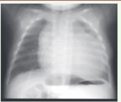 Figure 3. Cardiomégalie chez un nourrisson atteint de déficit en  a -glucosidase  (maladie de Pompe) (iconographie : Dr François Sassolas et Pr Marc Nicolino,  Lyon, France).