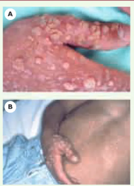 Figure  1. Définition  de  la  maladie  à  HPV.  A.