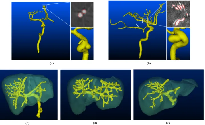 Fig. 3: (Top row) Results on two 3D rotational angiographies of the skull. For both segmentations of the arterial tree, we provide a 3D surface rendering view and two close-ups to demonstrate the ability of the algorithm to separate tangent vessels (top) a