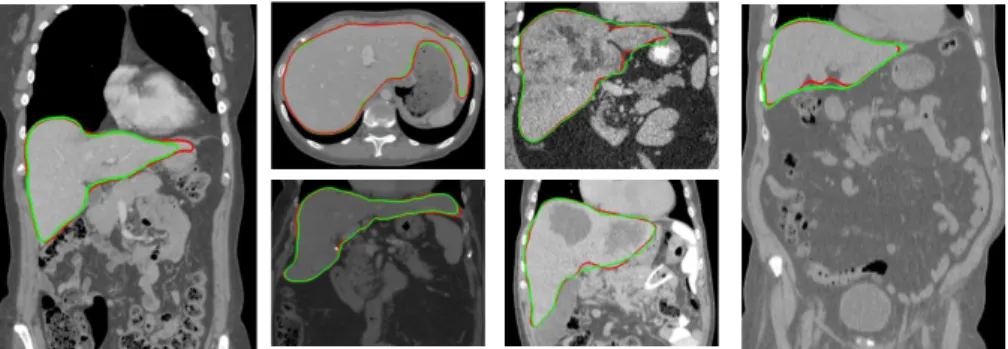 Fig. 5: Examples of segmentation results (red: ground truth, green: our result) in varied situations: different fields of view, liver contrast, shape and pathologies.