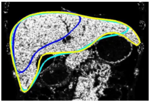 Table 1: Parameters used for global-to-local segmentation. J ψ α λ Heart I L ◦ Id 0.8 0.1 Liver step 1 M l Id ◦ G r 0.4 − step 2 M l L ◦ G s 0.8 0.03 step 3 M l L ◦ Id 1 0.01