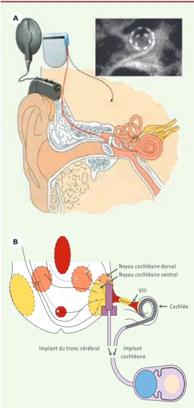 Figure 4. Implants cochléaire et du tronc cérébral. Ces implants se composent d’une  partie  externe  (microphone  et  microprocesseur  réunis  dans  un  contour d’oreille)  et  d’une  partie  implantée  soit  dans  la  cochlée,  soit  dans  le  noyau coch