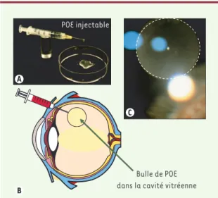 Figure  2.  Utilisation  d’un  polymère  injectable  dans  la  cavité vitréenne. Le POE (poly-oethoester), polymère visqueux  injec-table  pour  l’application  ophtalmologique