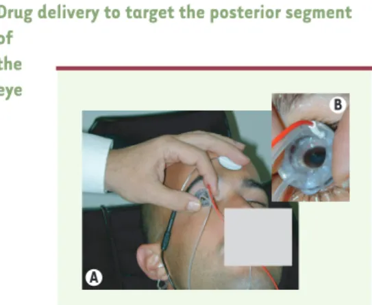 Figure  3. Patient  subissant  un  traitement  d’iontophorèse transsclérale. L’iontophorèse  transsclérale  est  une  méthode basée sur l’utilisation d’un champ électrique de basse tension qui augmente la perméabilité cellulaire d’une molécule  préfé-renti