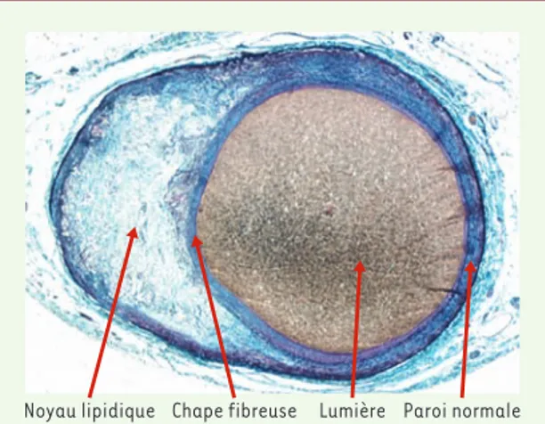 Figure  1. Plaque  stable  dans  une  artère  coronaire  fixée  sous pression,  avec  chape  fibreuse  épaisse  et  remodelage   excen-trique  permettant  le  maintien  d’un  calibre  luminal  normal (collection du Pr S