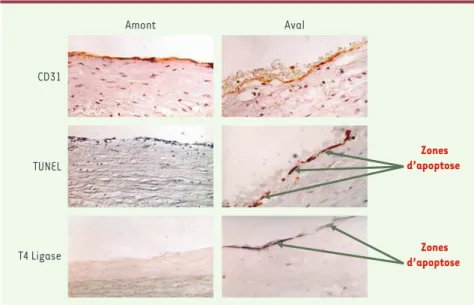 Figure 2. Distribution de l’apoptose des cellules endothéliales en amont et en aval de la sténose maximale  d’une  plaque  d’athérosclérose  carotidienne  humaine