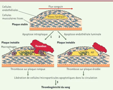 Figure 3. Rôles potentiels de l’apoptose dans l’instabilité de la plaque d’athérosclérose