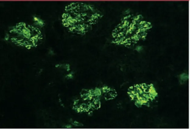 Figure 1. Dépôts mésangiaux d’IgA. Les dépôts d’IgA sont révé- révé-lés  par  immunofluorescence  directe  à  l’aide  d’anticorps   fluo-rescents  anti-IgA  humaines  au  cours  de  la  maladie  de  Berger.