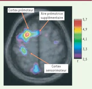 Figure 2. Représentation combinée des images de tomographie par émission de positons et d’imagerie par résonance  magné-tique illustrant l’augmentation du débit sanguin lors de la marche imaginée