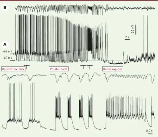 Figure 1. Transformation de l’activité électrique du sommeil à ondes lentes vers une activité paroxystique de type crise Lennox-Gastaut