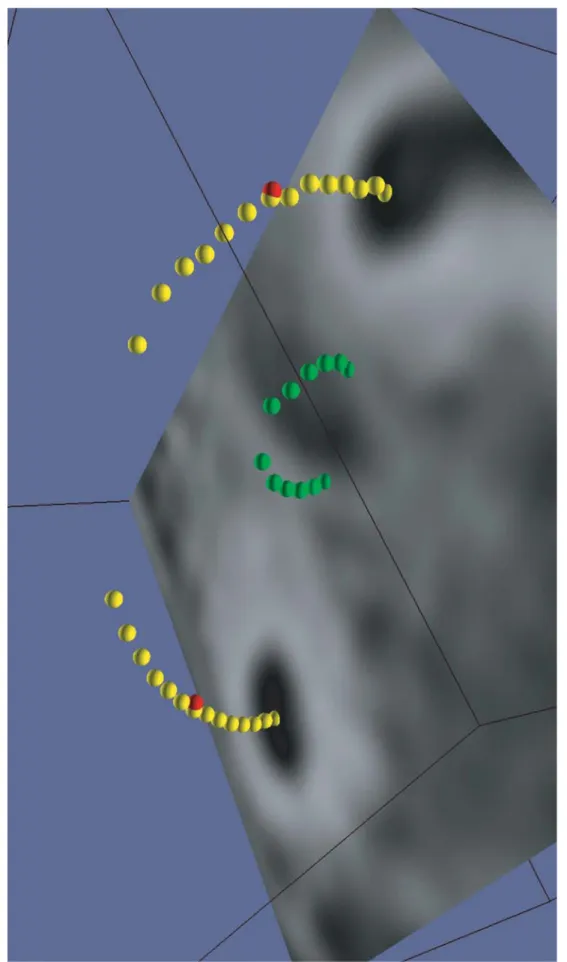 Fig. 2. Aspect de la fossa subarcuata (zone ovale en vert) entre les deux lumières du canal semi-circulaire antérieur (en jaune).