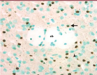 Figure 1. Inclusions intranucléaires et agrégats extranucléaires dans le striatum d’une souris transgénique R6/2