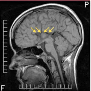 Figure 1. Imagerie par résonance magnétique en coupe sagit- sagit-tale T1 montrant une agénésie complète du corps calleux chez un patient québécois de 23 ans atteint de neuropathie  sensiti-vomotrice héréditaire avec agénésie du corps calleux (NSMH/ACC)