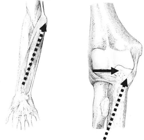 Figure VI: Schematic illustration showing a strong medial keel on the elbow articulation (from Schmitt, 2003).