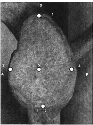 Figure VIII: Points taken on the shoulder, lateral view. The superior (1), middle (5) and inferior (3) points form the SI angle and the anterior (2), middle (5) and posterior (4) points form the AP angle.