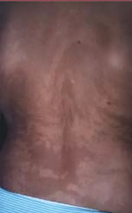 Figure 2. Lignes de Blaschko dans la région dorsale d’une femme atteinte d’incontinentia pigmenti.