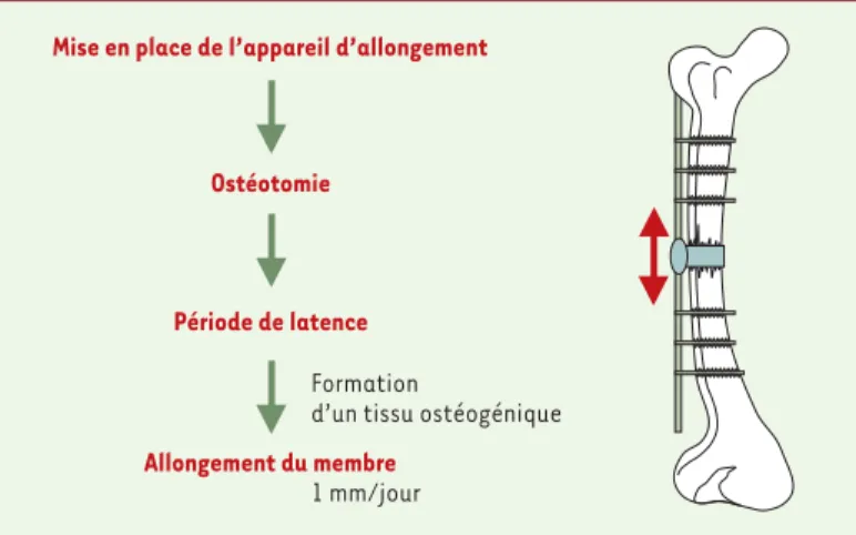 Figure 1. Technique de dis-traction osseuse. Après section de la corticale osseuse et formation d’un tissu ostéogène, on exerce un allongement  progres-sif du membre