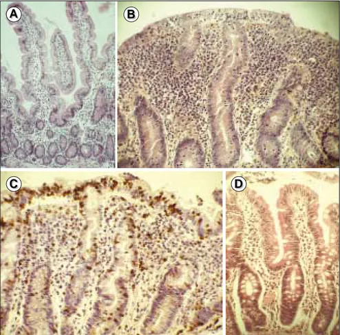 Figure 1. Modifications histologiques au cours de la maladie cœliaque. Biop- Biop-sies duodénales fixées par le formol et colorées par l’hématéine-éosine (A, B, D) ou en immunohistochimie par une technique d’immunoperoxydase (C) (X250)