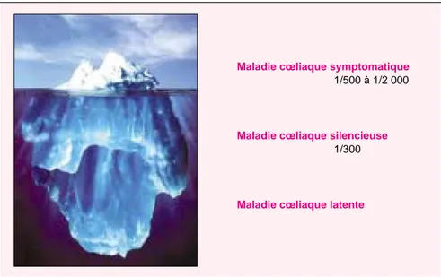 Figure 2. L’iceberg de la maladie cœliaque. L’expression clinique très variable de la maladie cœliaque a été comparée par A