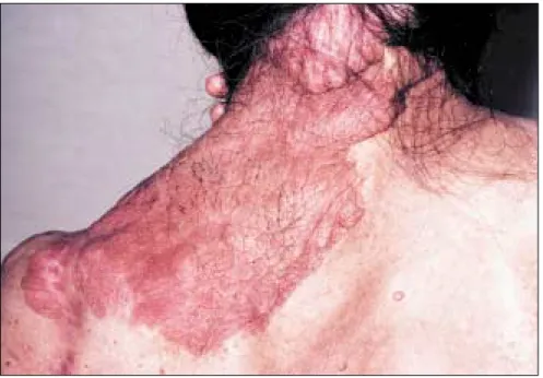 Figure 3. Neurofibrome plexiforme.