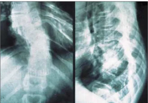 Figure 8. Scoliose thoracique.