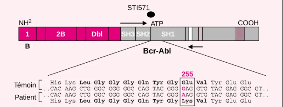 Figure 1. Séquençage du domaine tyrosine kinase de BCR-ABL identifiant une mutation ponctuelle substituant un A par un G en position 255 du domaine tyrosine kinase d’ABL résultant en la substitution d’un acide  gluta-mique par une lysine.