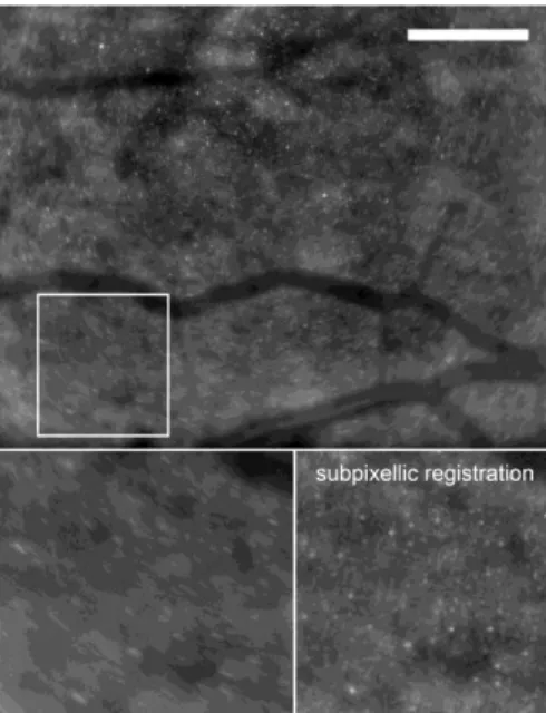 Figure  1.  Imaging  of  the  normal  cone  mosaic  by  adaptive  optics  (AO) flood illumination imaging (bar, 300µm)