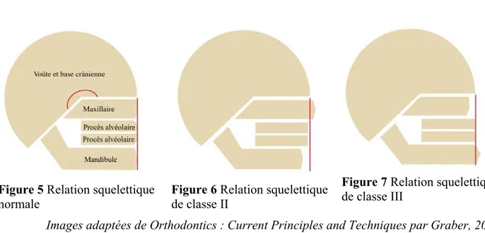 Figure 8 Différents types de profils et malocclusion associée  Images adaptées de Textbook of Orthodontics par Bishara, 2011 