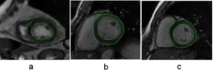 Fig. 4. Results of the automatic segmentation shown for (a) apical level, (b) median level and (c) basal level slices.