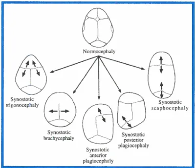 figure 6: Différents types de cran ioynostoses selon la suture impliquée (Cohen et MacLean, 2000)