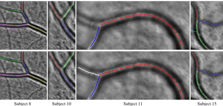 Figure 5: Good (half-left) and poor (half-right) results from Table 2 for the automatic detection of axial reflections for four distinct subjects