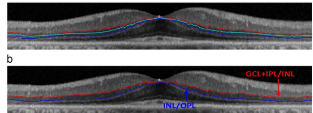 Fig. 16. Final segmentation in various stages (a and b) of Retinitis Pigmentosa evolution.