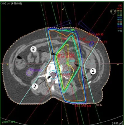 Figure 2.2 : Un exemple de plan de traitement visant une tumeur de l’abdomen. Les lignes pleines correspondent aux isodoses en pourcentage de la dose de prescription