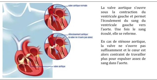 Figure 2: Rétrécissement de la valve aortique 