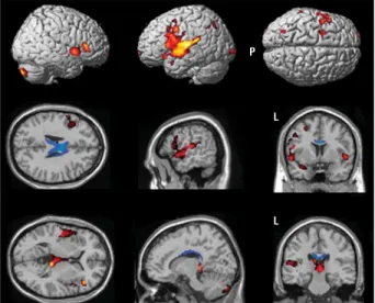 Table 3. Locations of the Peaks of Regional Reduction in Fractional Anisotropy in Patients With CBDS Compared With Controls