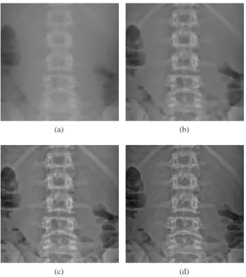 Fig. 3: Crop from a spine image; dose = 14.64 µ Gy: (a) Low contrast and noisy image, (b) EOS-LD, (c) EOS-MD, (d) Our method.