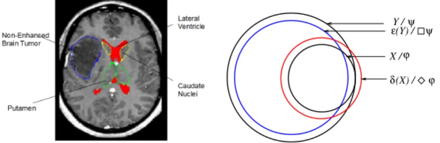 Fig. 2. Left: pathological brain with a tumor. Finding a high level interpretation of the image can be formalized as an abduction problem, where the knowledge base contains expert knowledge and the observation is the image and segmentation results