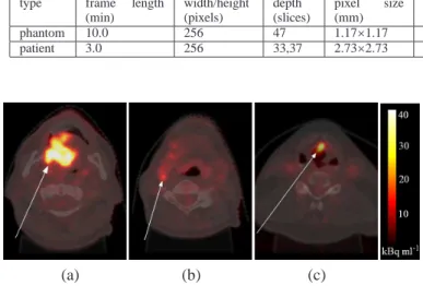 Fig. 3: Axial neck slices of 18 F-FDG PET images overlain on simultaneous CT. (a) &amp; (b) Oral cavity tumour &amp; lymph node metastasis in patient 1 (c) Laryngeal tumour in patient 2.