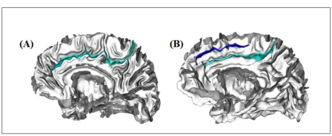 Figure 6 : motifs sulcaux du cortex cingulaire antérieur, (A) cerveau avec un sillon cingulaire : motif  symétrique  (bleu  clair),  (B)  cerveau  avec  sillon  cingulaire  et  un  sillon  para-cingulaire  :  motif  asymétrique (bleu foncé)
