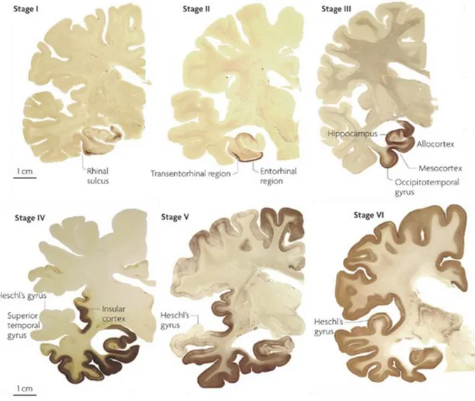 Figure  2.  Braak  staging  for  Tau  pathology  in  AD.  NFT  accumulation  begins  in  the  transentorhinal  cortex  (stage  I),  progresses  to  the  entorhinal  cortex  (stage  II),  reaches  the  hippocampus  (stage  III)  and  other  limbic  areas  (