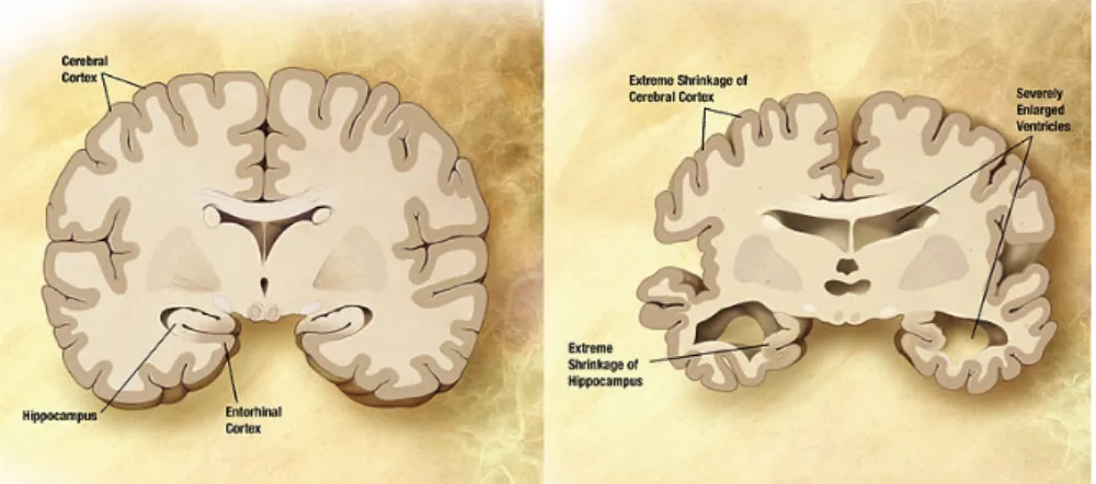 Figure 2.2: Combinaison de deux sch´ emas de cerveau pour illustrer la variabilit´ e entre un cerveau normal et un pathologique
