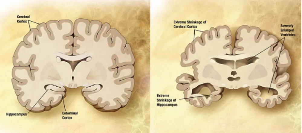 Figure 4.2: Combination of two brain diagrams to illustrate pathological brain variability