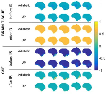 Figure 3. Bloch simulation results of the T 2 -preparation module. Assuming perfect spoiling, the result  is represented as the longitudinal magnetization (units of M 0 ) for the brain tissue (top) and CSF (bottom)