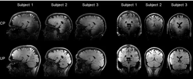 Figure 6. Comparison of the FLAIR-SPACE CP (top row) and pTx-UP (bottom row) acquisitions in  representative sagittal and coronal slices for 3 subjects (subjects 1 to 3)